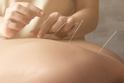 Acupuncture needles